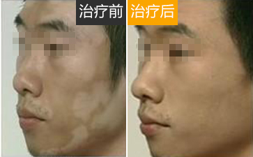 南通面部出现白癜风后要如何护理
